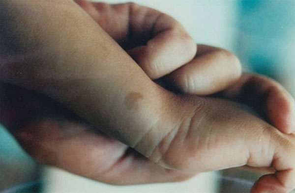 Vết bớt trên tay câu bé K. H. trùng vị trí với nơi người ta dùng muội than đánh dấu lên thi thể người ông. (Ảnh: Scientific Exploration)